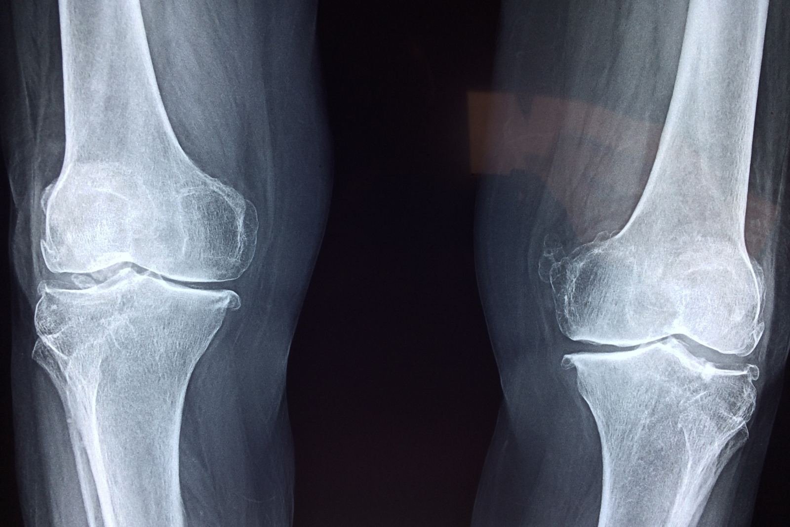 Radiografía de rodillas con desgaste articular